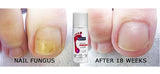 Footlogix Nail Tincture Spray 足樂適 7T 天然抗甲菌噴霧劑 （灰甲寶）